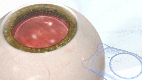 「薄瓣半飞秒」和「晶体植入」，谁才是高度近视的救星？