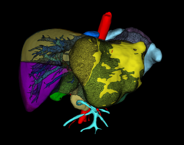 多学科协作 西安交大二附院肝胆胰外科急诊切除破裂巨大肝癌