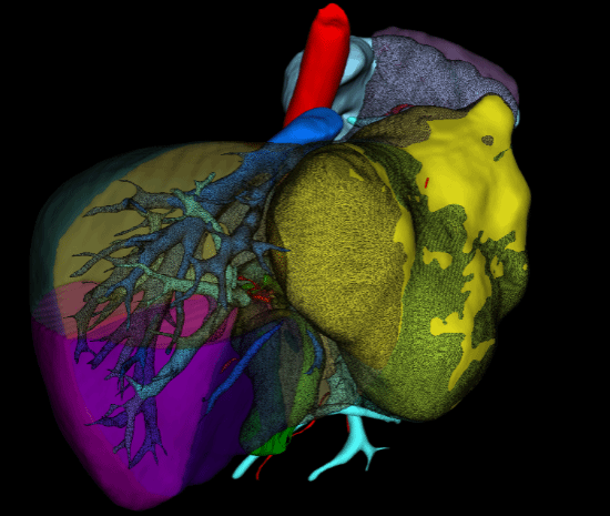 多学科协作 西安交大二附院肝胆胰外科急诊切除破裂巨大肝癌