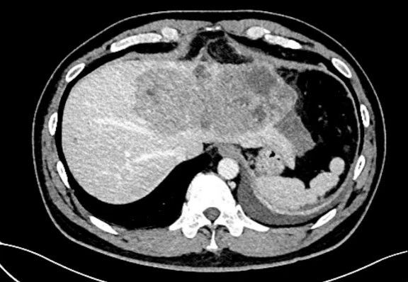 多学科协作 西安交大二附院肝胆胰外科急诊切除破裂巨大肝癌