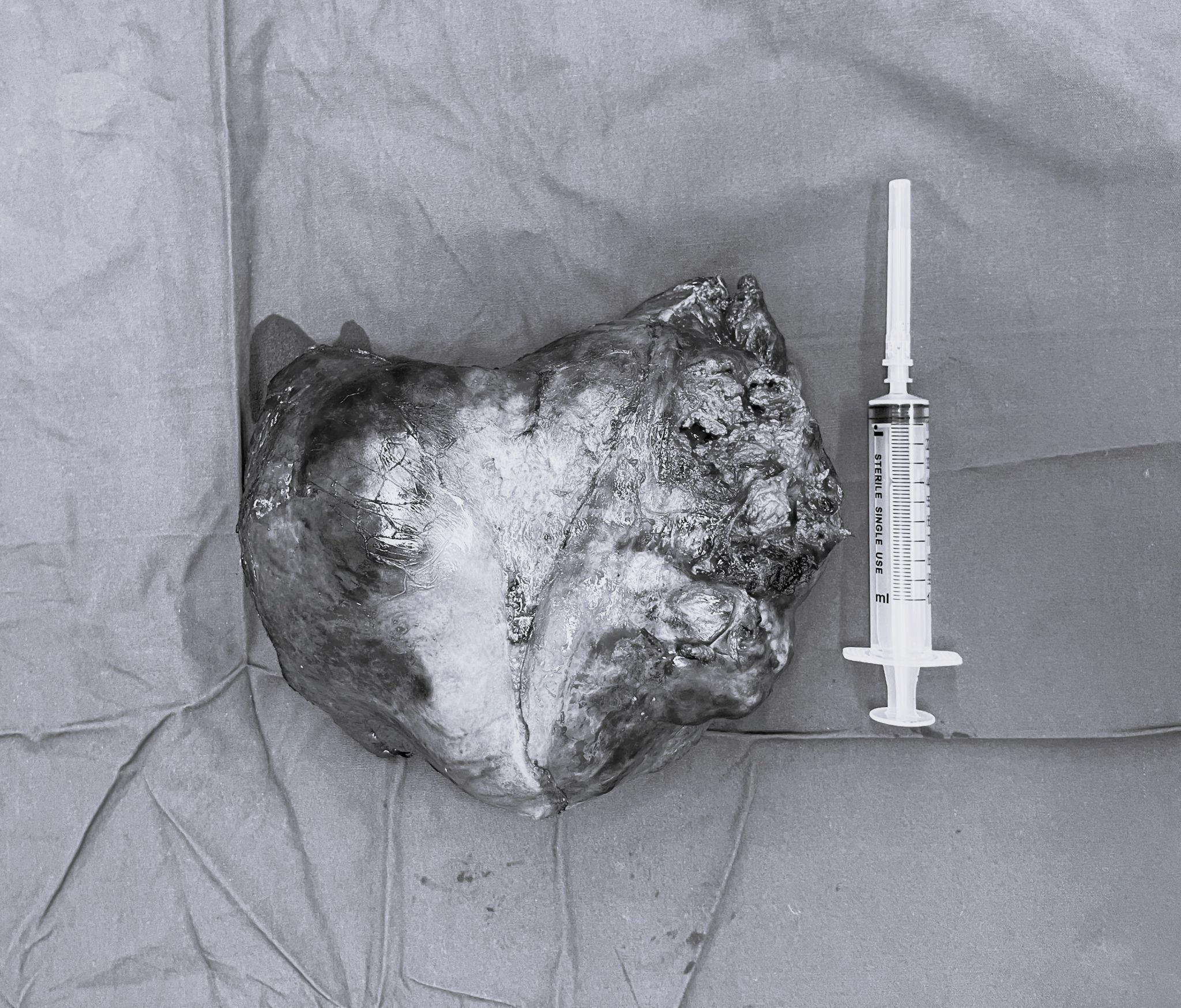 多学科协作 西安交大二附院肝胆胰外科急诊切除破裂巨大肝癌