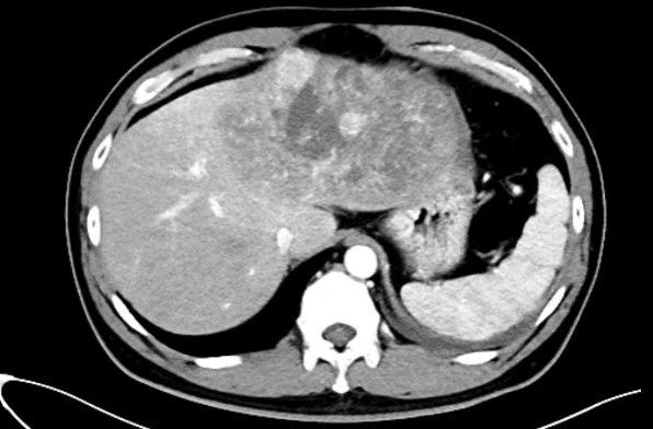 多学科协作 西安交大二附院肝胆胰外科急诊切除破裂巨大肝癌