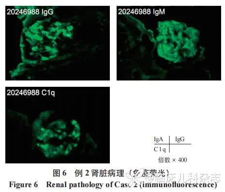 儿童共患 ANCA 相关性血管炎肾损害双胞胎一对报告