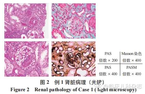 儿童共患 ANCA 相关性血管炎肾损害双胞胎一对报告