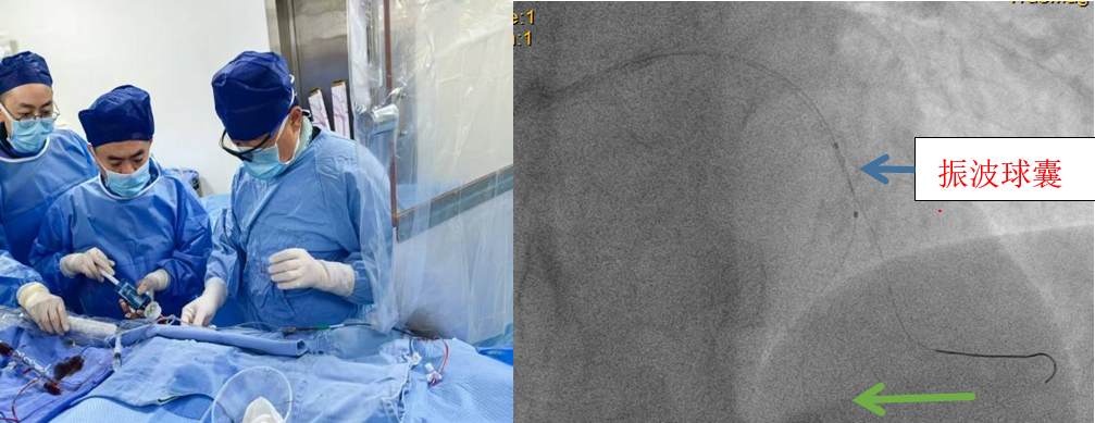 突破「血管钙化」禁区！绵阳市中心医院实施川西北首例震波球囊技术