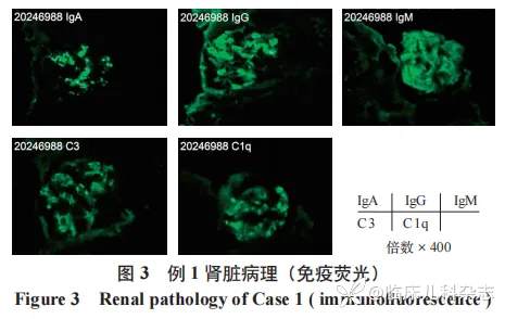 儿童共患 ANCA 相关性血管炎肾损害双胞胎一对报告