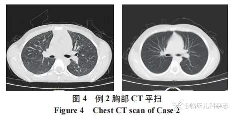 儿童共患 ANCA 相关性血管炎肾损害双胞胎一对报告