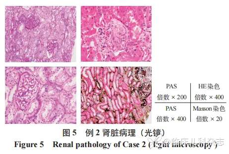 儿童共患 ANCA 相关性血管炎肾损害双胞胎一对报告
