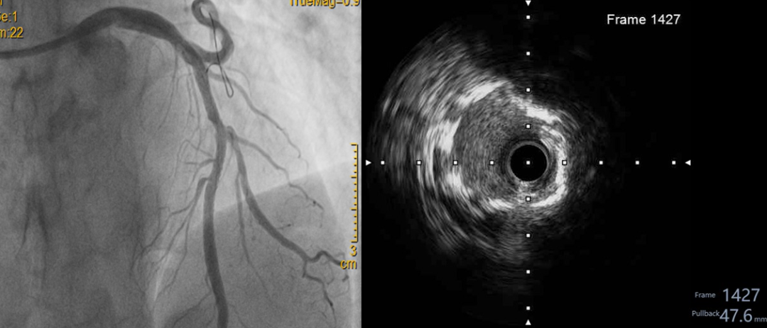 突破「血管钙化」禁区！绵阳市中心医院实施川西北首例震波球囊技术