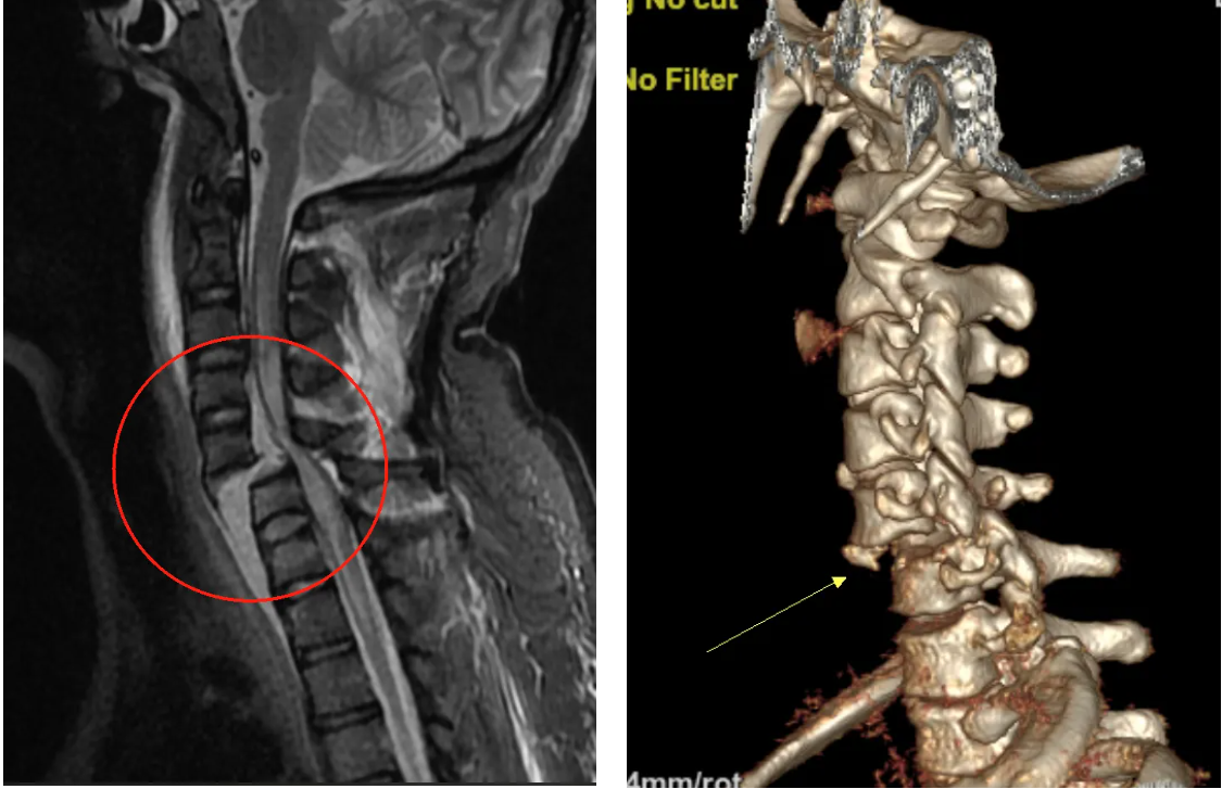 车祸致高位截瘫!松山医院骨科联手多学科挑战禁区、「断颈」归位
