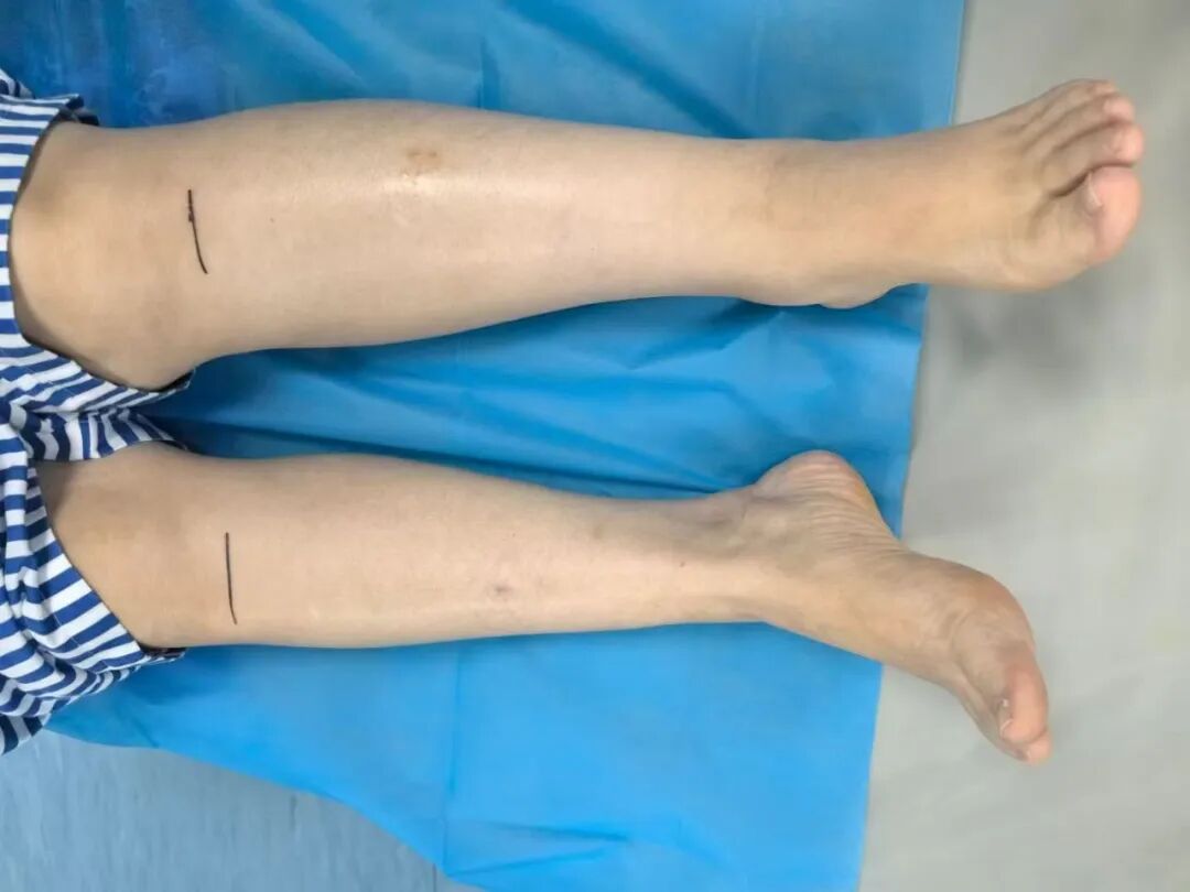 一条腿粗一条腿细？可能是出现这个原因