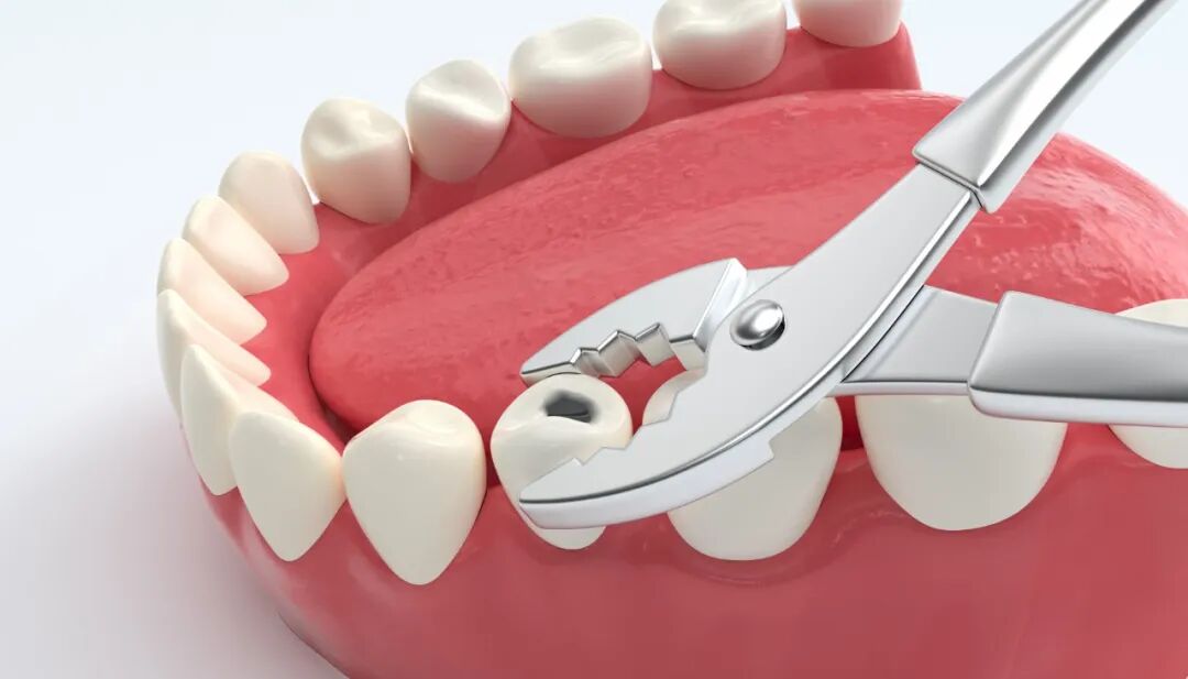 拔牙后为什么不建议你吐口水?