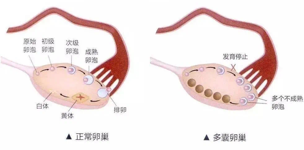 多囊卵巢 = 不孕？别急，生殖科医生告诉你…