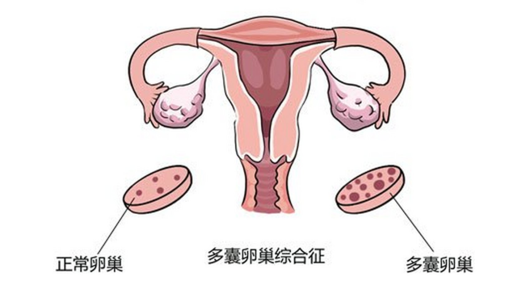 多囊卵巢 = 不孕？别急，生殖科医生告诉你…