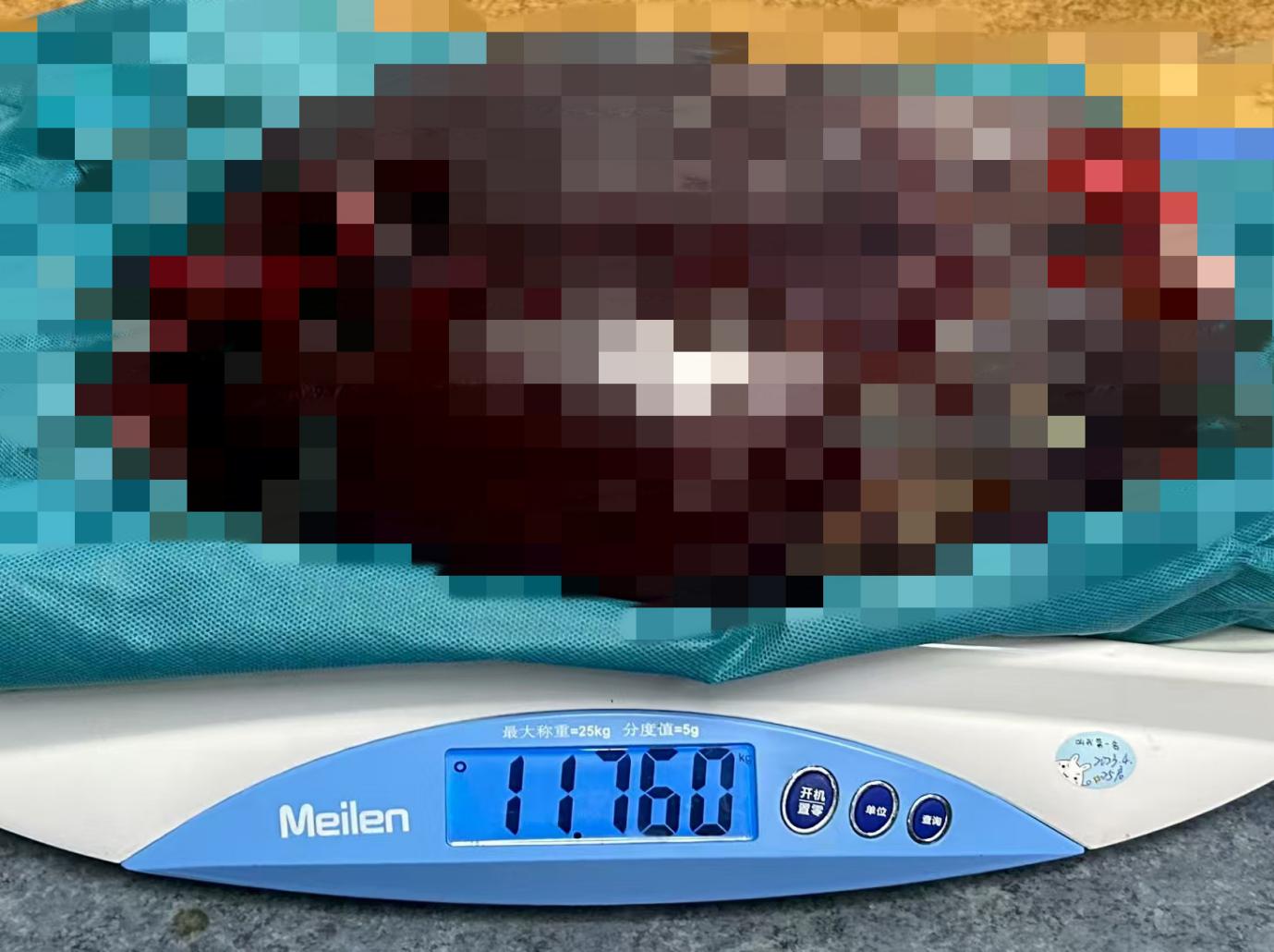 罕见!南昌大学二附院肝胆外科成功为患者切除近 24 斤巨型脾脏