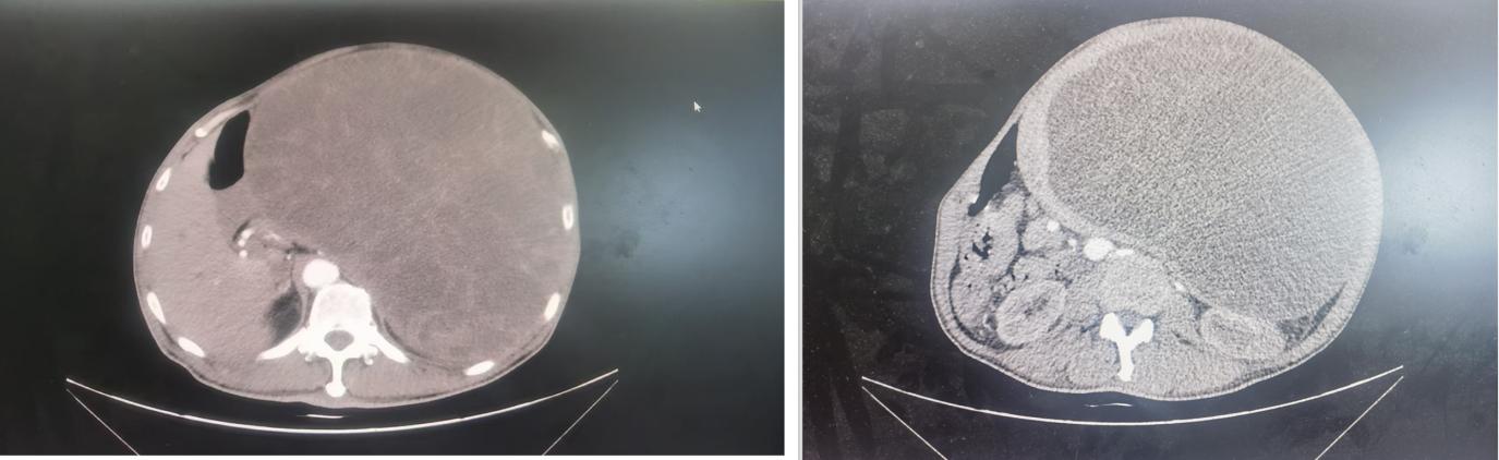 罕见!南昌大学二附院肝胆外科成功为患者切除近 24 斤巨型脾脏