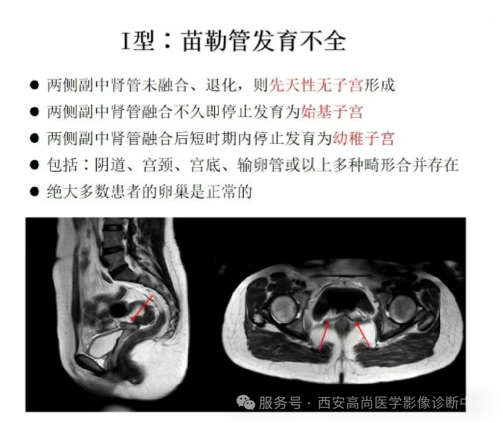 【高尚病例】纵隔子宫