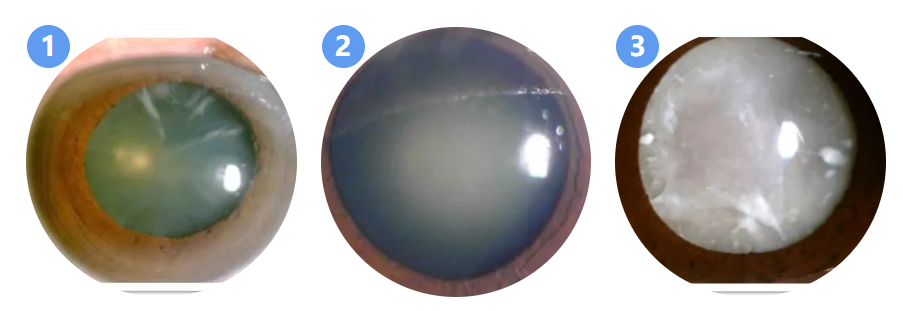 警惕!这个致盲杀手——白内障