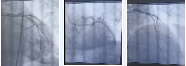 5 次电击除颤+急诊 PCI 术！延安市中医院挽救 50 岁心梗患者为生命护航