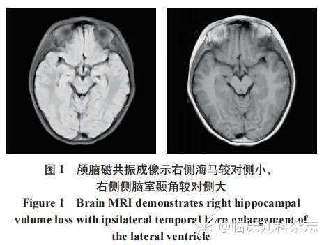 以抽动障碍为首发症状的抗 DPPX 抗体相关性自身免疫性脑炎 1 例报告