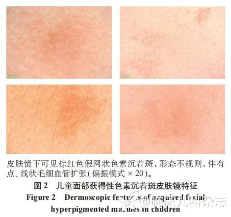 儿童面部获得性色素沉着斑 54 例临床表现、皮肤镜特征及预后分析