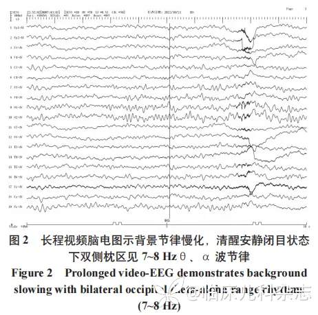 以抽动障碍为首发症状的抗 DPPX 抗体相关性自身免疫性脑炎 1 例报告