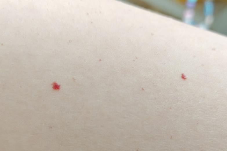 身上突然冒出来的小红点,到底是啥啊?