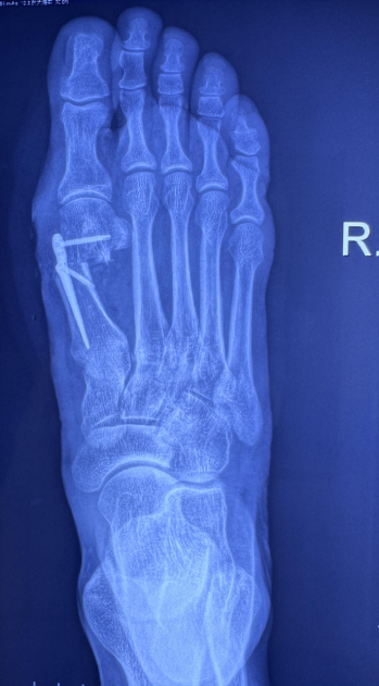 三代微创精准矫正——多学科联合为复杂足拇外翻患者重启"步履新生"