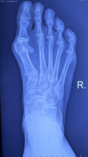 三代微创精准矫正——多学科联合为复杂足拇外翻患者重启"步履新生"