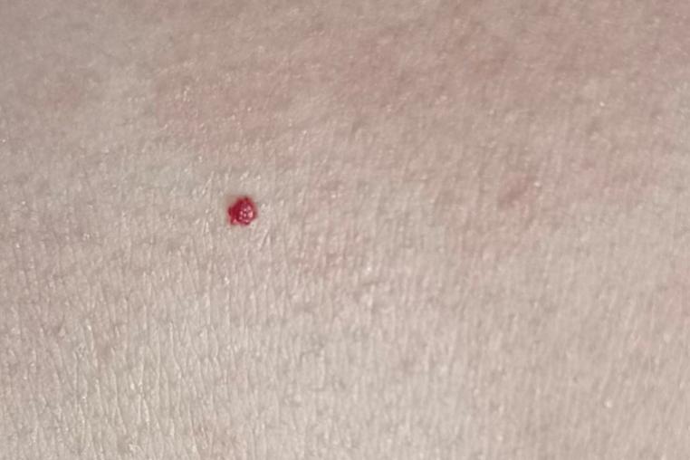 身上突然冒出来的小红点,到底是啥啊?