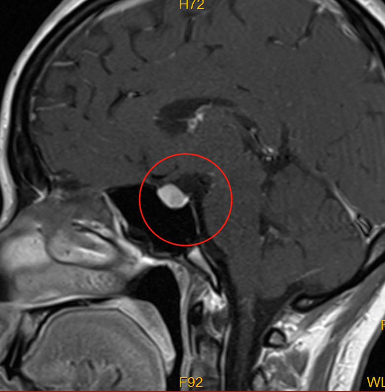 别被「普通头痛」骗了！29 岁女子脑子里藏着「定时炸弹」！