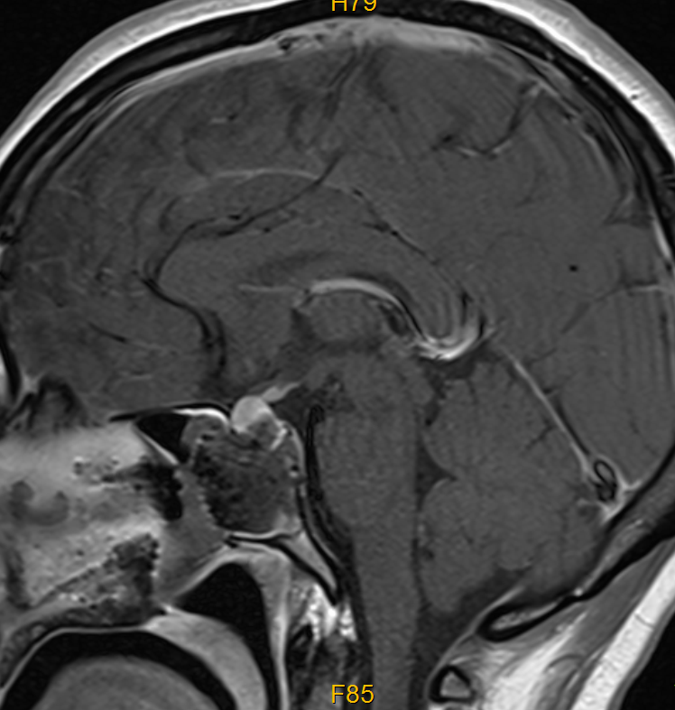 别被「普通头痛」骗了！29 岁女子脑子里藏着「定时炸弹」！