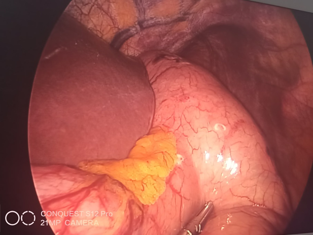 双镜联合精确解决早期胃癌「保胃」「切胃」两难问题