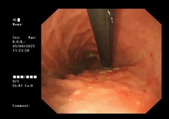 双镜联合精确解决早期胃癌「保胃」「切胃」两难问题