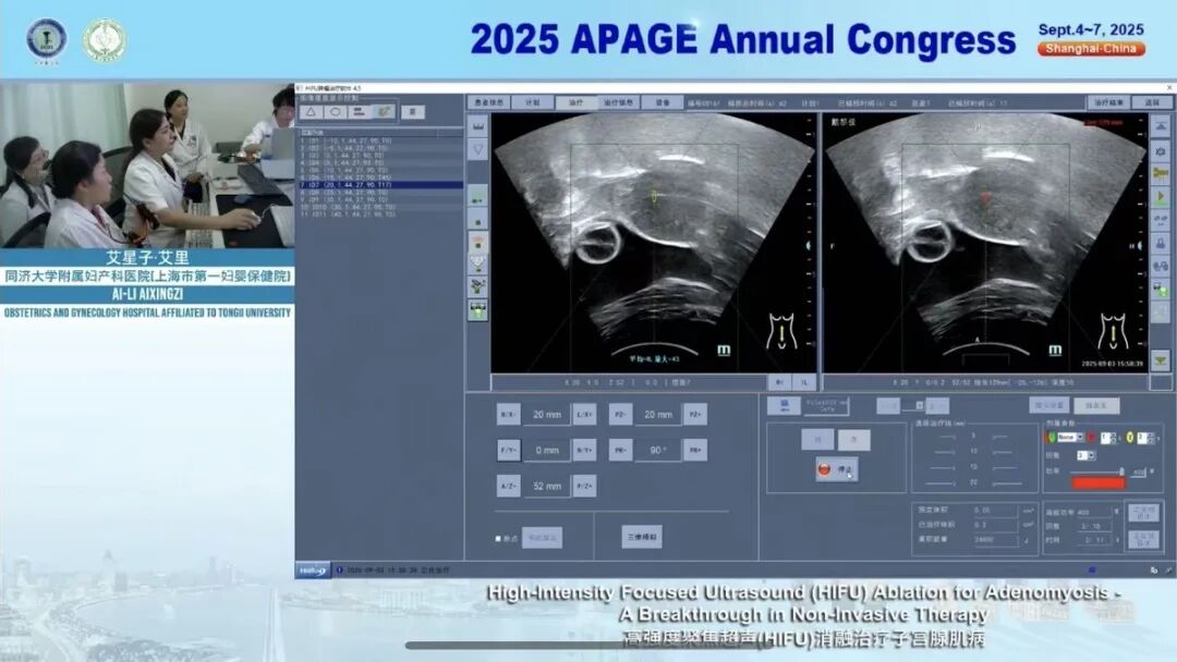 重庆海扶医院专家团队出席 2025 APAGE Annual Congress 聚焦超声 Workshop