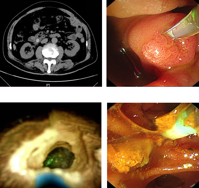 七旬老人胆管化脓合并胰腺炎，多学科联合微创取石成功脱险