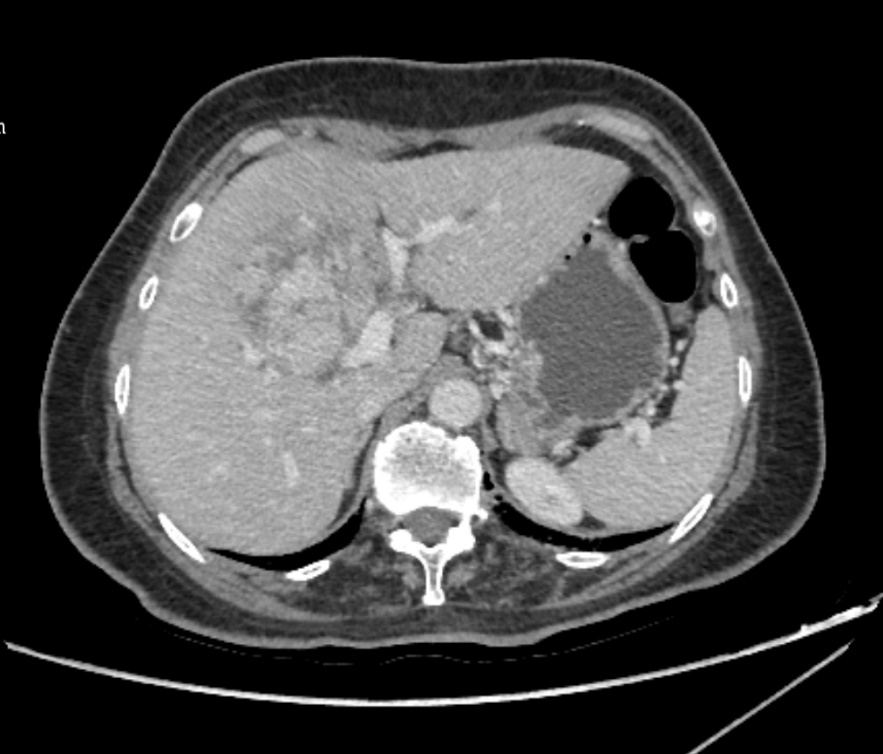 桂医二附院成功完成首例经腹腔镜荧光引导下精准切除肝脏「中央区」肿瘤