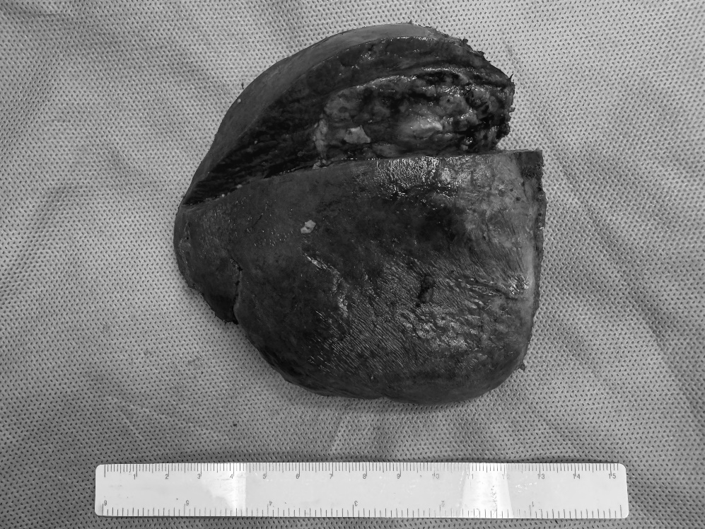 桂医二附院成功完成首例经腹腔镜荧光引导下精准切除肝脏「中央区」肿瘤