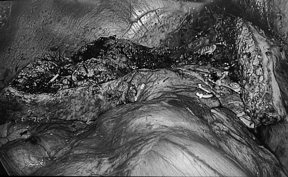 桂医二附院成功完成首例经腹腔镜荧光引导下精准切除肝脏「中央区」肿瘤