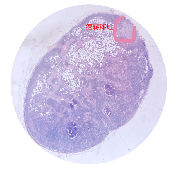 切一片而知全貌是真的吗？为你揭秘术中冰冻与常规病理的真相