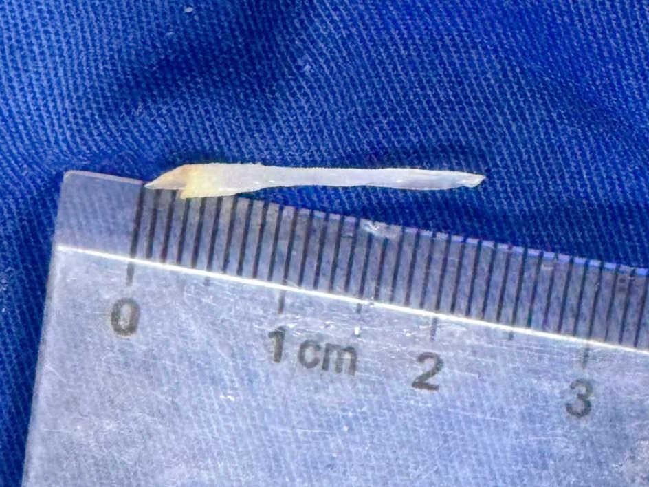 「夺命鱼刺」威胁 93 岁老人，集团医院深夜联动成功排险