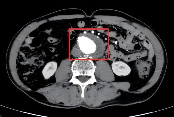 微创拆「弹」，南京江北医院成功实施首例主动脉瘤覆膜支架植入术