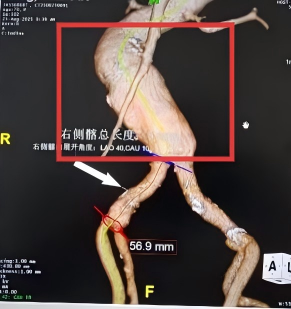 微创拆「弹」，南京江北医院成功实施首例主动脉瘤覆膜支架植入术
