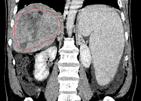肝硬化患者必读：定期影像复查是阻击肝癌的「生命警报器」！