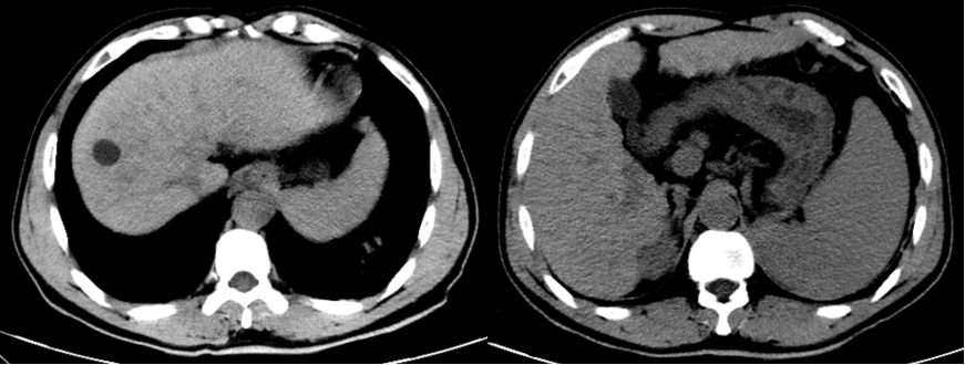 肝硬化患者必读：定期影像复查是阻击肝癌的「生命警报器」！