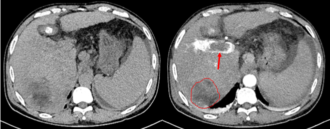 肝硬化患者必读：定期影像复查是阻击肝癌的「生命警报器」！