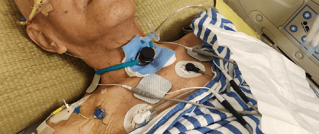 七旬老人重症肺炎呼吸衰竭,历经 3 个月中西医结合康复成功拔管重获新「声」