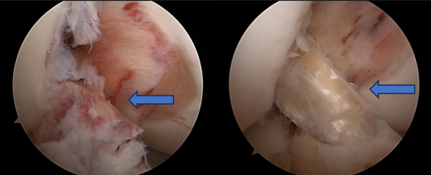 桂医大二附院成功实施前交叉韧带内增强重建术，助力快速康复