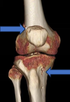 桂医大二附院成功实施前交叉韧带内增强重建术，助力快速康复