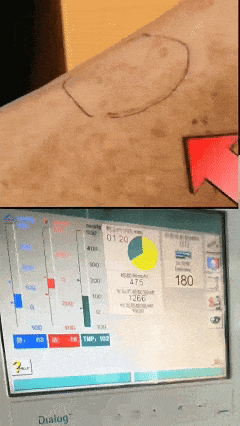 血透患者的「生命线」突然频频报警，微创解决「堵车」问题